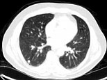 The gorilla was spotted by only four out of 24 radiologists when asked to examine the CT scans of 5 different patients lungs